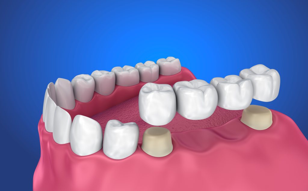 Dental Bridges