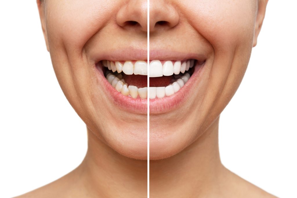 Veneers in Thornton
