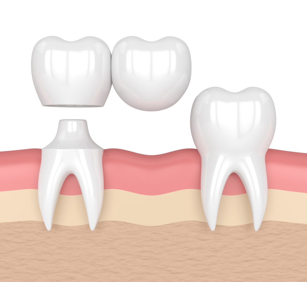 Dental crown fitting over a prepared tooth in 3D illustration