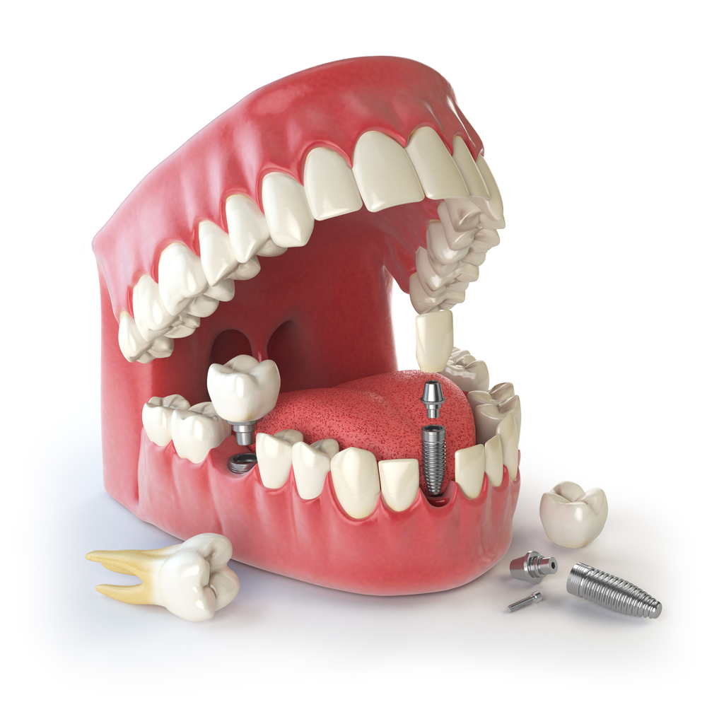3D illustration of dental implants in lower jaw